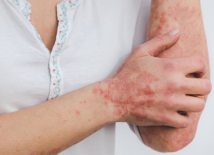 best homeopathic medicine for eczema