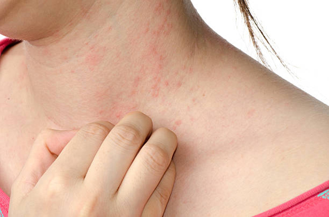 Best Homeopathic Medicine for Eczema