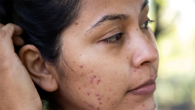 Pimple Marks Remove Tips