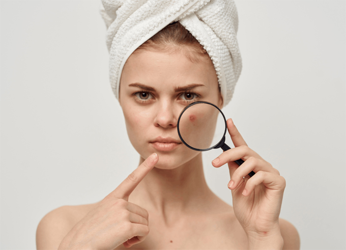 Acne Treatment Tips At Home