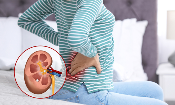 How To Get Rid of Kidney Stones
