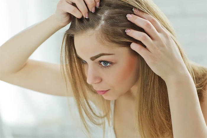 Natural Remedies for Treating Dandruff