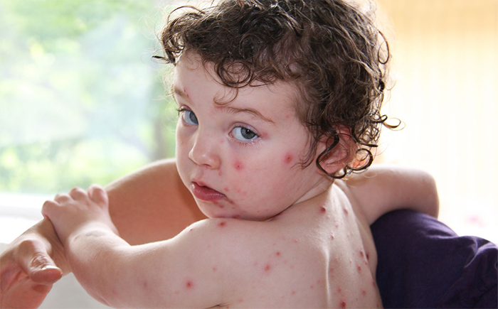 Natural Remedies for Chickenpox