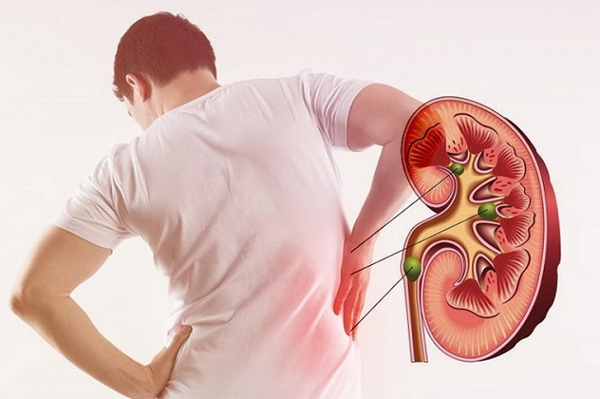 How To Get Rid of Kidney Stones