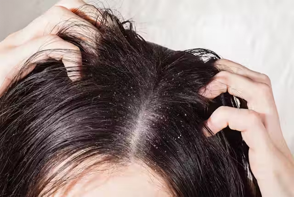 Beauty Benefits of Tea Tree Oil